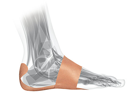 Plantar Fasciitis Insoles & Treatment  Buyers Guide