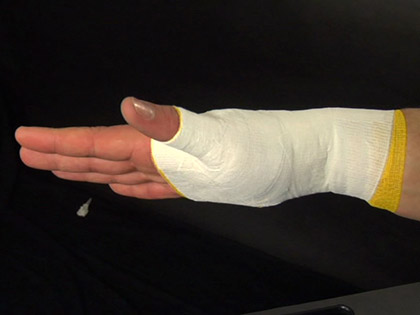 Post Injury Taping: Thumb 