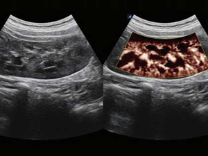 Contrast enhancement ultrasound