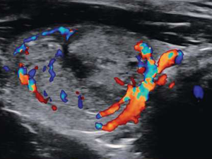 Directional Power Doppler Imaging