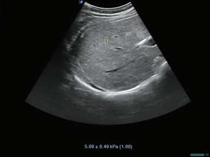 Point shear wave elastography