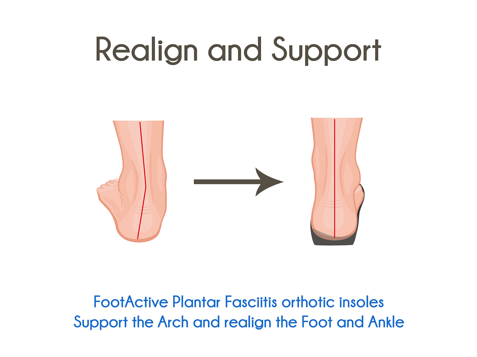 FootActive® Plantar Fasciitis